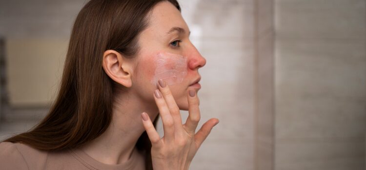 Lupus Treatment Options: Symptoms, Diagnosis & Alternative Treatments 5 Lupus Symptoms