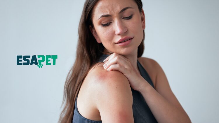 Lupus treatment